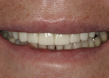 Healthy white smile