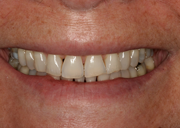 Yellowed and worn smile