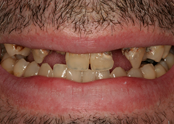 Yellowed and worn smile