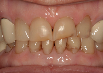 Yellowed and worn smile