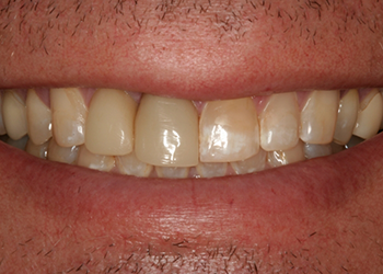 Yellowed and worn smile