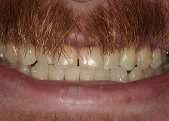 Yellowed and worn smile