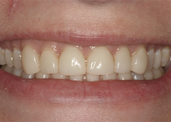 Yellowed and worn smile