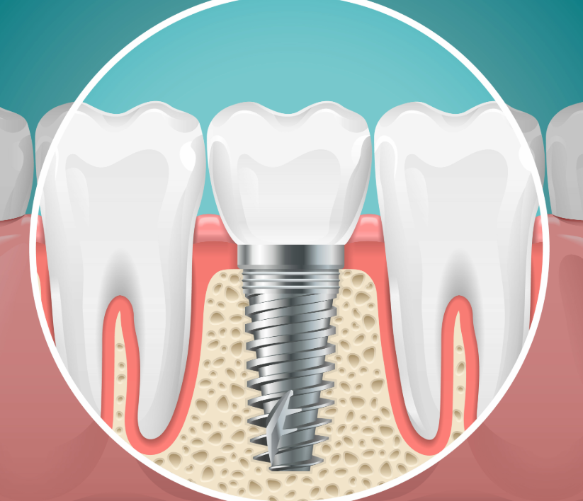 Illustrated cross section of a dental implant